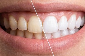 Close-up of woman’s smile before and after teeth whitening