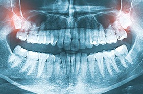 Dental X-ray showing two impacted wisdom teeth