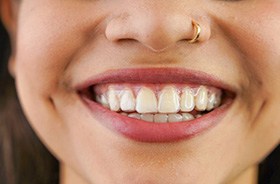 Close-up of woman’s smile with Invisalign aligner on her teeth