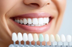 Woman’s smile next to dental shade guide