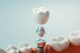 Illustration of traditional dental implant, abutment, and crown