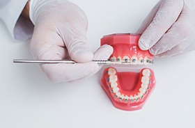 Gloved hands holding dental model, explaining braces treatment