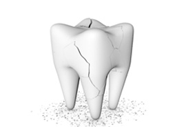 Illustration of cracked tooth that may need root canal therapy and a crown