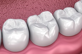 Graphic of dental bonding