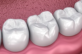 Graphic of dental bonding