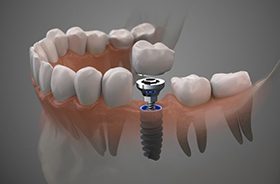 Illustration of dental implant between natural teeth