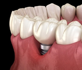 Patient smiling after dental implant failure and salvage in Woodbridge