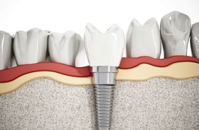 Illustration of healthy dental implant between natural teeth