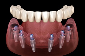 Illustration of implant dentures for lower dental arch