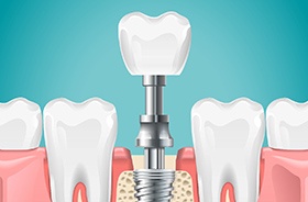 diagram of dental implant placement in Woodbridge