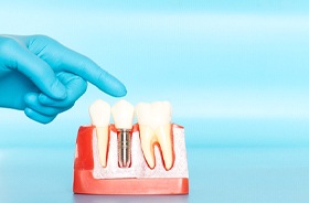 Finger pointing at implant model integrated with surrounding bone