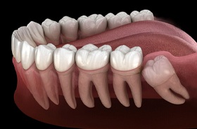 wisdom tooth illustration