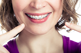 Closeup of teeth with traditional braces