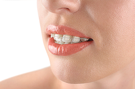 Closeup of smile with tooth-colored braces