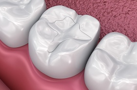 Graphic of tooth-colored fillings