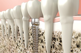 dental implant illustration