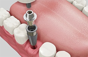 disassembled dental implant