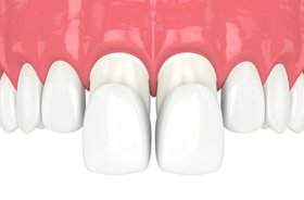 illustration of porcelain veneers being applied to two front teeth