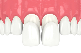 illustration of porcelain veneers being applied to two front teeth