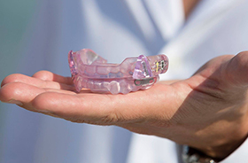 Hand holding an oral appliance