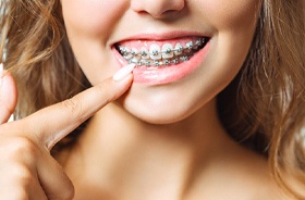 Close-up of woman pointing to traditional braces in Woodbridge