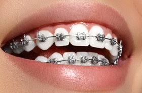 Woman’s smile with white teeth and metal braces