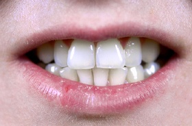 Close-up of misaligned teeth in need of orthodontic treatment