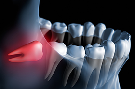 Animation of impacted wisdom tooth