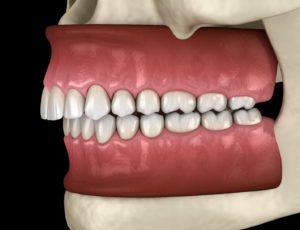 Illustration of overbite, a bite problem that Invisalign in Woodbridge can fix