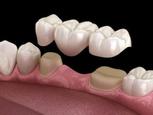 Illustration of three-unit dental bridge in Woodbridge being placed on teeth