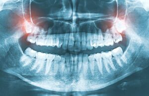 Dental X-ray showing impacted wisdom teeth 